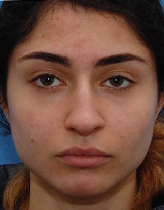 Rhinoplasty Before & After Gallery - Patient 131292 - Image 8