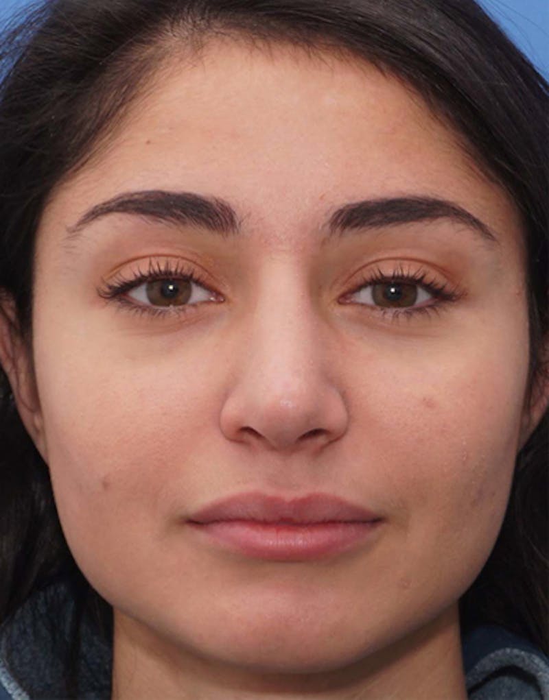 Rhinoplasty  Before & After Gallery - Patient 131292 - Image 7