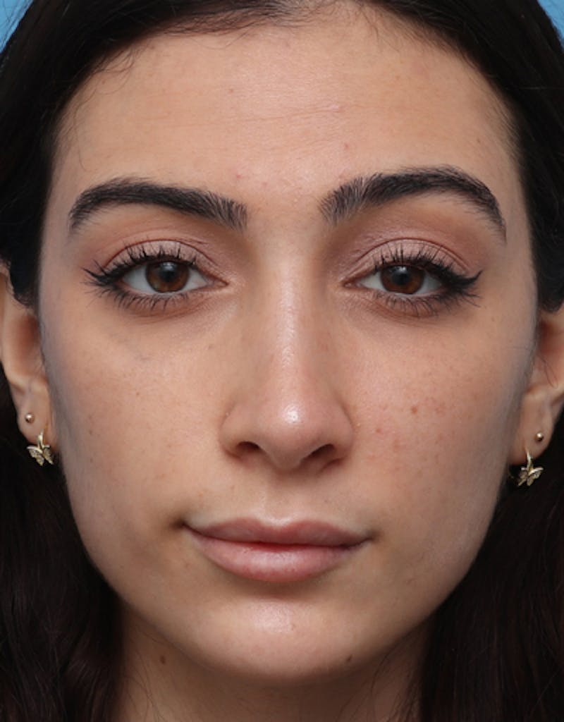 Rhinoplasty Before & After Gallery - Patient 416860 - Image 4