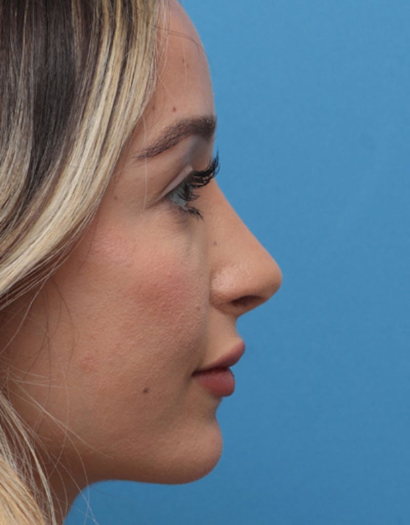 Rhinoplasty Before & After Gallery - Patient 283162 - Image 2