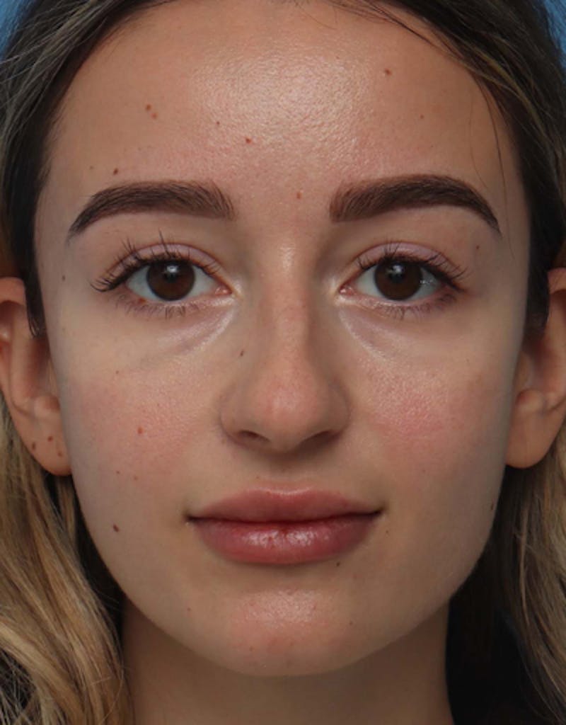 Rhinoplasty Before & After Gallery - Patient 283162 - Image 3