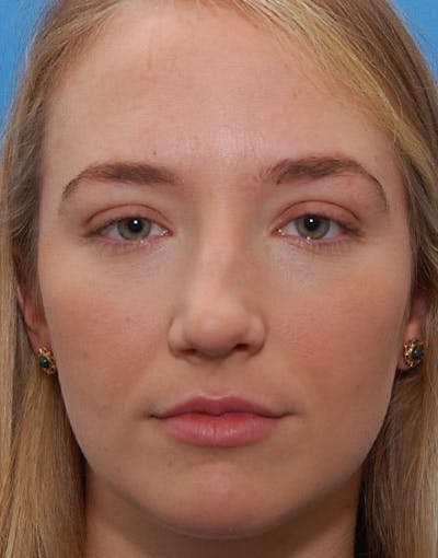 Rhinoplasty Before & After Gallery - Patient 615536 - Image 1