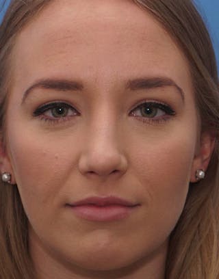 Rhinoplasty Before & After Gallery - Patient 615536 - Image 2