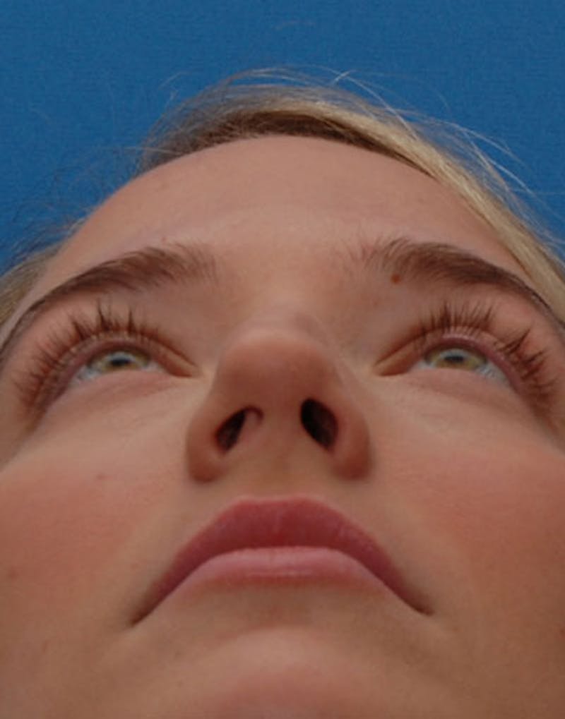 Rhinoplasty  Before & After Gallery - Patient 615536 - Image 7