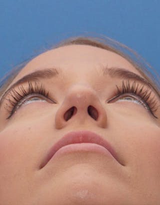 Rhinoplasty Before & After Gallery - Patient 615536 - Image 8