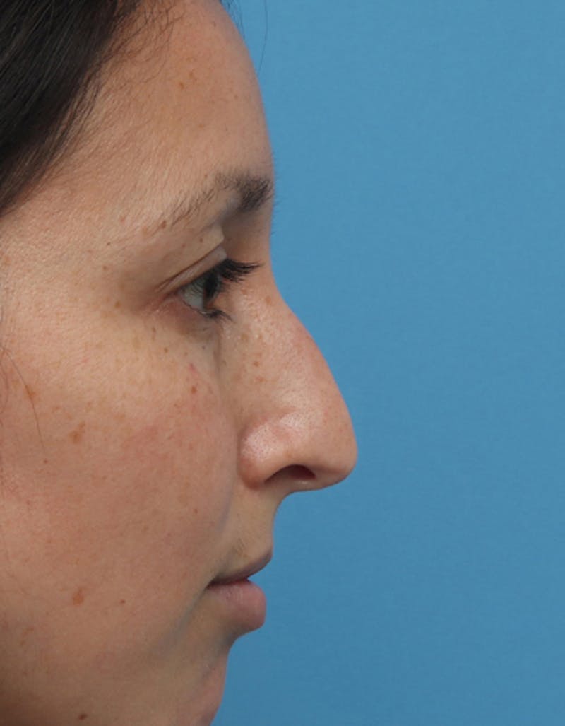Rhinoplasty Before & After Gallery - Patient 120087 - Image 1