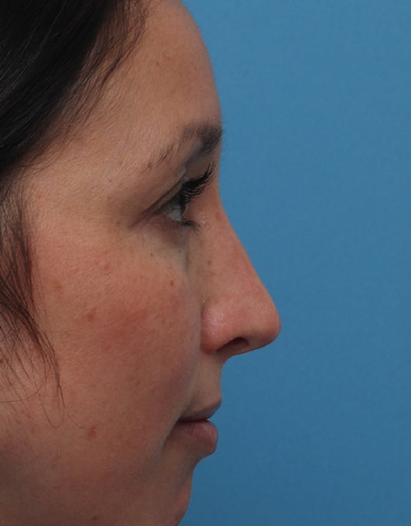 Rhinoplasty Before & After Gallery - Patient 120087 - Image 2