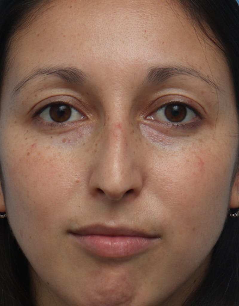 Rhinoplasty Before & After Gallery - Patient 120087 - Image 3