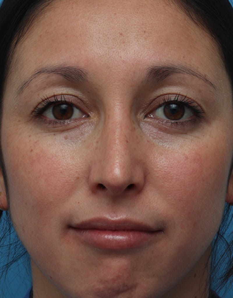 Rhinoplasty Before & After Gallery - Patient 120087 - Image 4