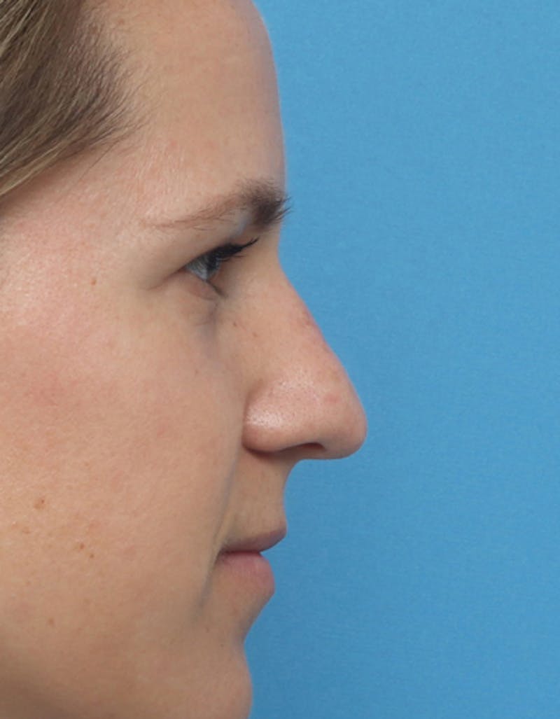Patient Hn7-ZLvUQmC44lSPDgBDAg - Rhinoplasty Before & After Photos