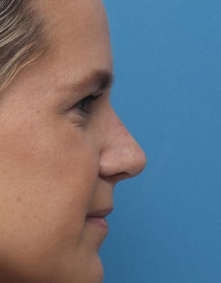 Rhinoplasty Before & After Gallery - Patient 352795 - Image 2