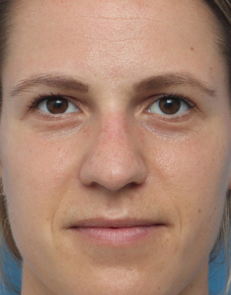 Rhinoplasty Before & After Gallery - Patient 190170 - Image 3