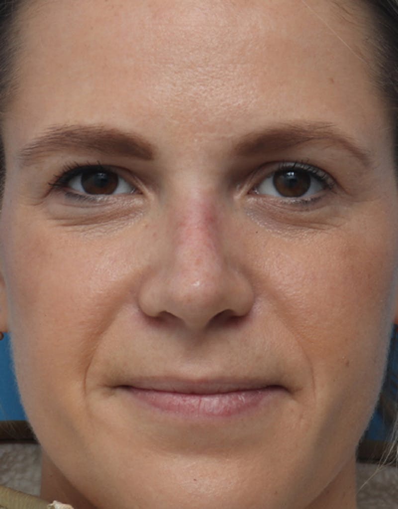 Rhinoplasty  Before & After Gallery - Patient 352795 - Image 4