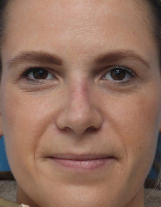 Rhinoplasty Before & After Gallery - Patient 352795 - Image 4