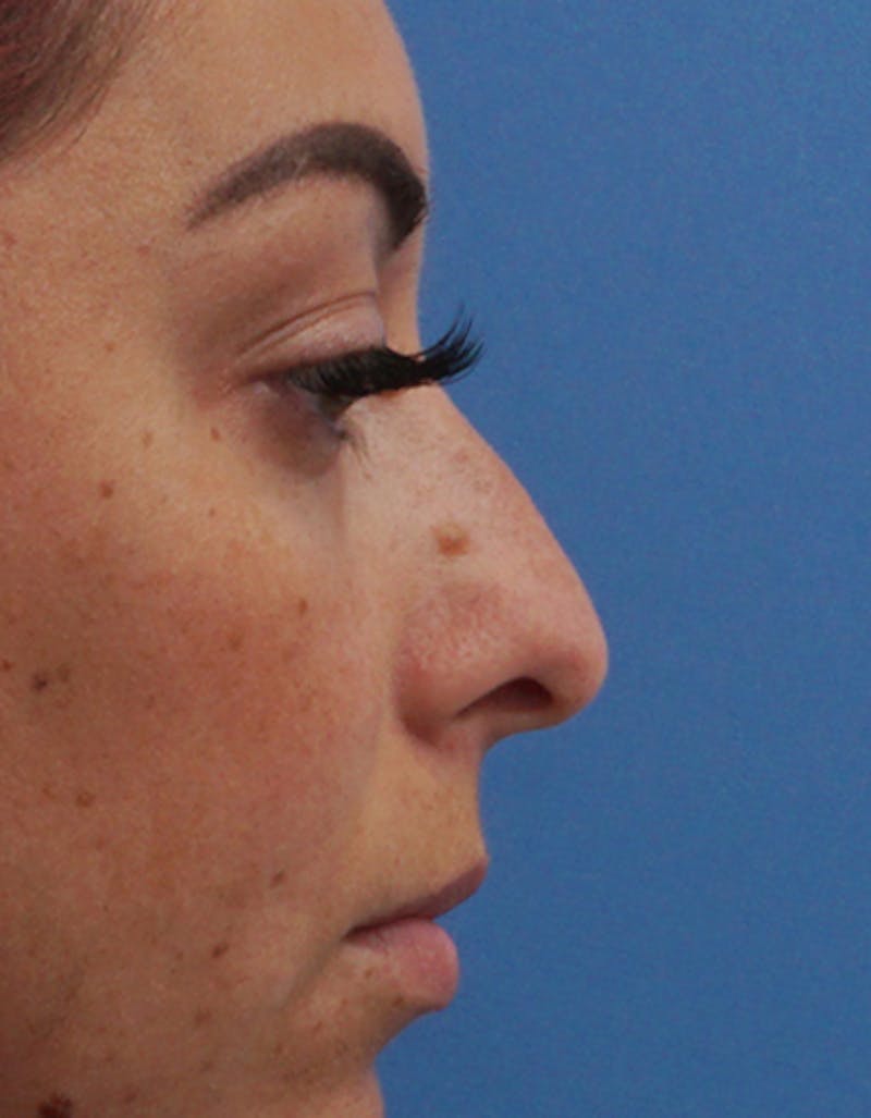 Rhinoplasty Before & After Gallery - Patient 350399 - Image 1