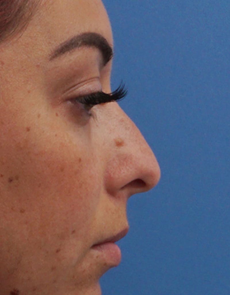 Patient Hzu6BBOKRkOLiLlc8kdOwQ - Rhinoplasty Before & After Photos