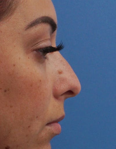 Rhinoplasty Before & After Gallery - Patient 386439 - Image 1