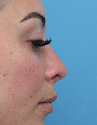 Rhinoplasty Before & After Gallery - Patient 386439 - Image 2