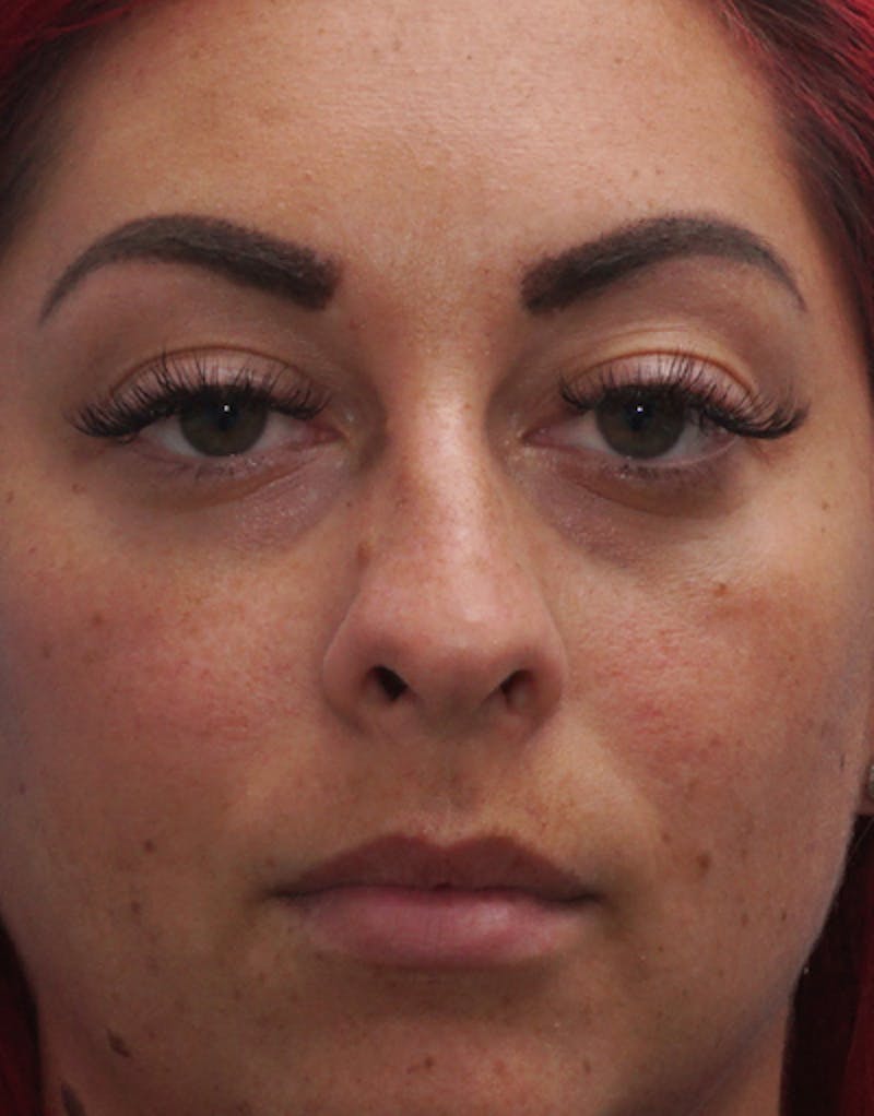 Rhinoplasty  Before & After Gallery - Patient 386439 - Image 3