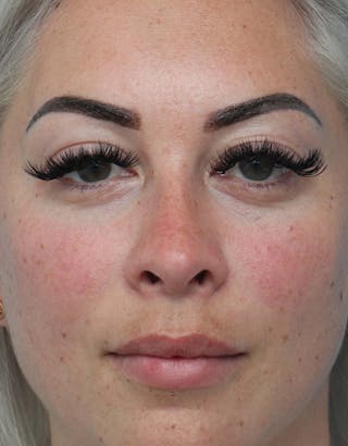 Rhinoplasty Before & After Gallery - Patient 386439 - Image 4