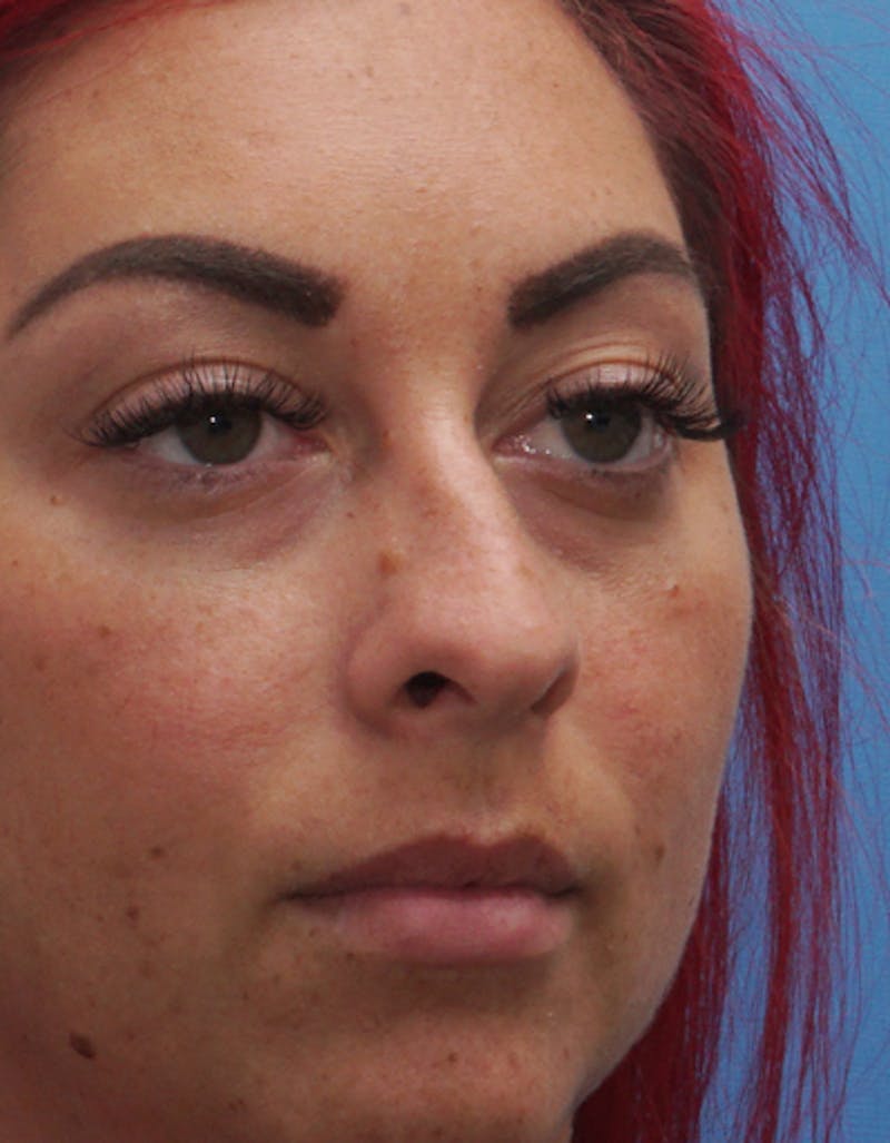Rhinoplasty Before & After Gallery - Patient 350399 - Image 5