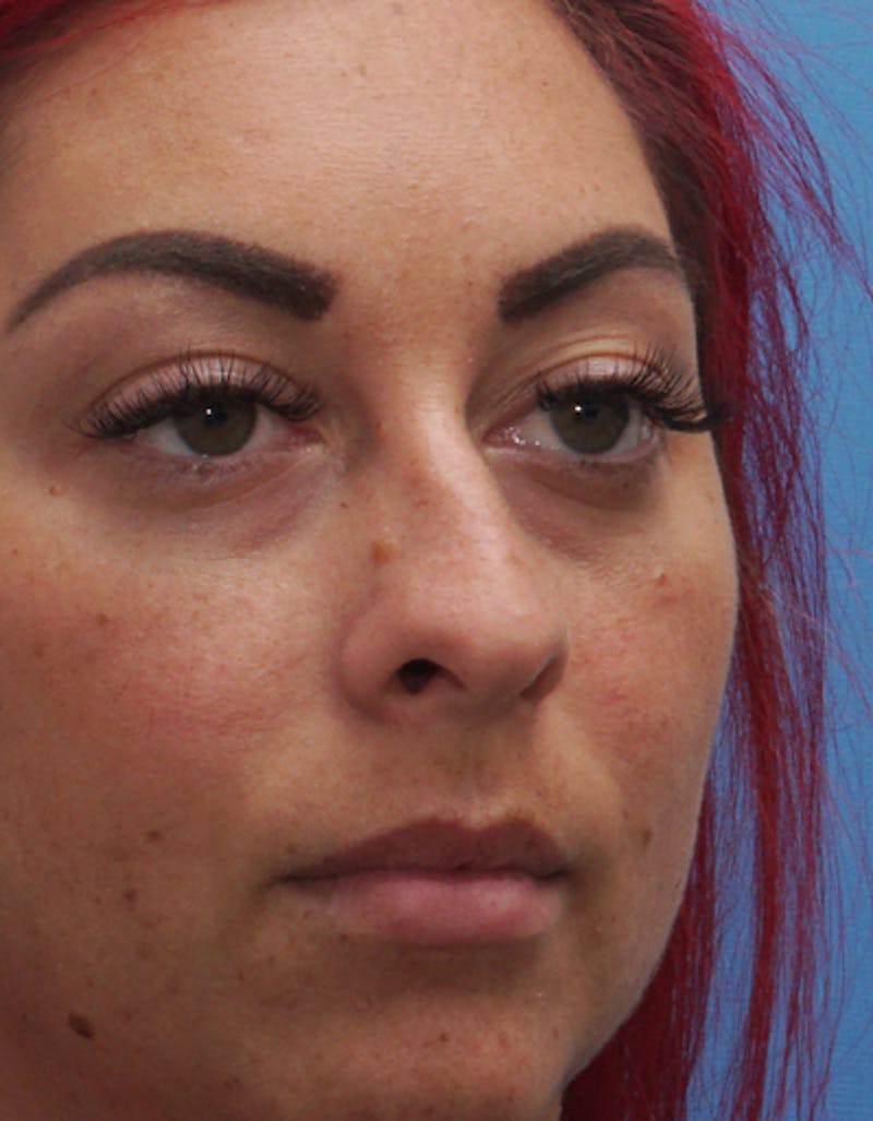 Rhinoplasty  Before & After Gallery - Patient 386439 - Image 5