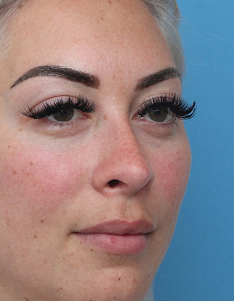 Rhinoplasty Before & After Gallery - Patient 350399 - Image 6