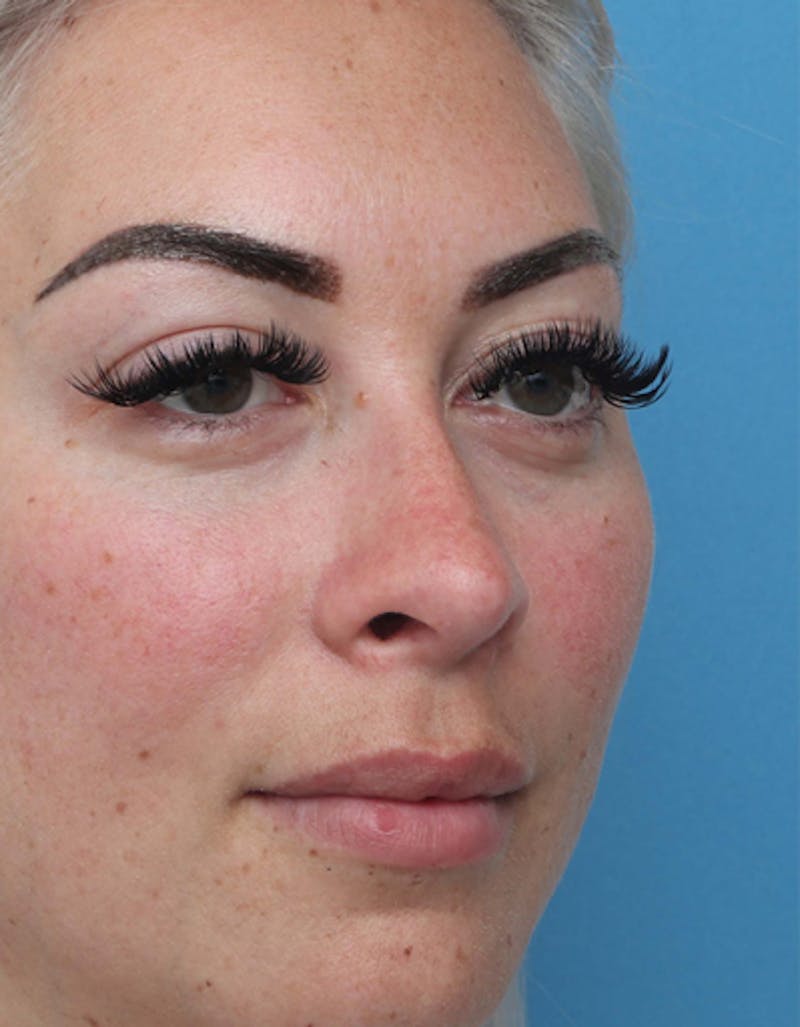 Rhinoplasty  Before & After Gallery - Patient 386439 - Image 6