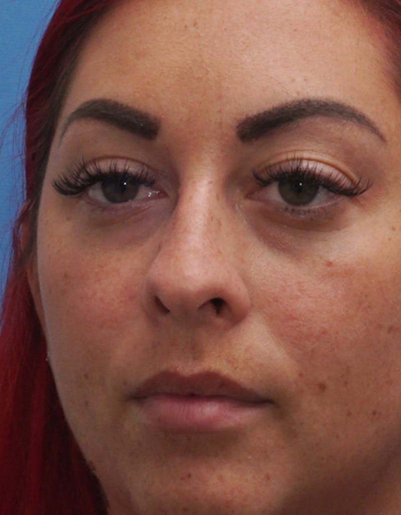 Rhinoplasty  Before & After Gallery - Patient 386439 - Image 7