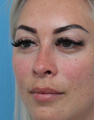 Rhinoplasty Before & After Gallery - Patient 386439 - Image 8
