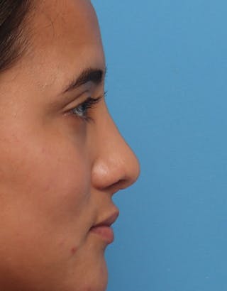 Rhinoplasty Before & After Gallery - Patient 359902 - Image 2