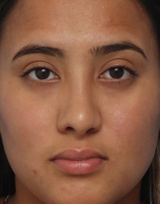 Rhinoplasty Before & After Gallery - Patient 359902 - Image 4
