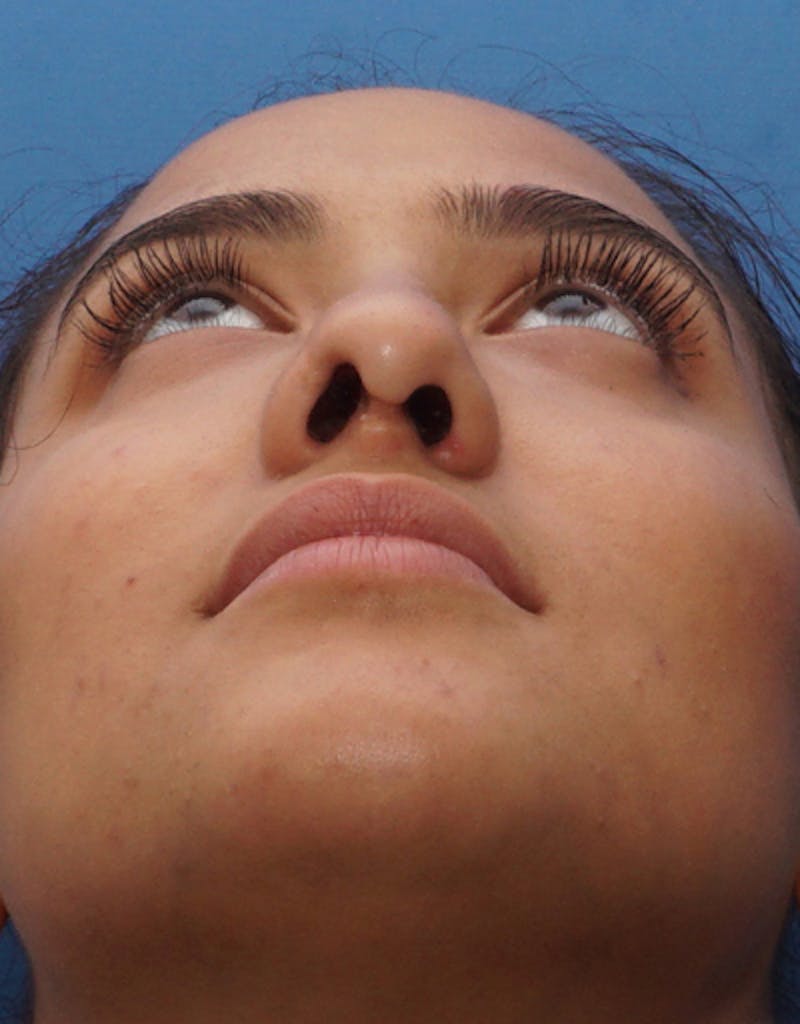 Rhinoplasty  Before & After Gallery - Patient 359902 - Image 5