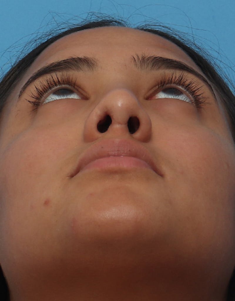 Rhinoplasty  Before & After Gallery - Patient 359902 - Image 6