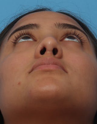 Rhinoplasty Before & After Gallery - Patient 359902 - Image 6