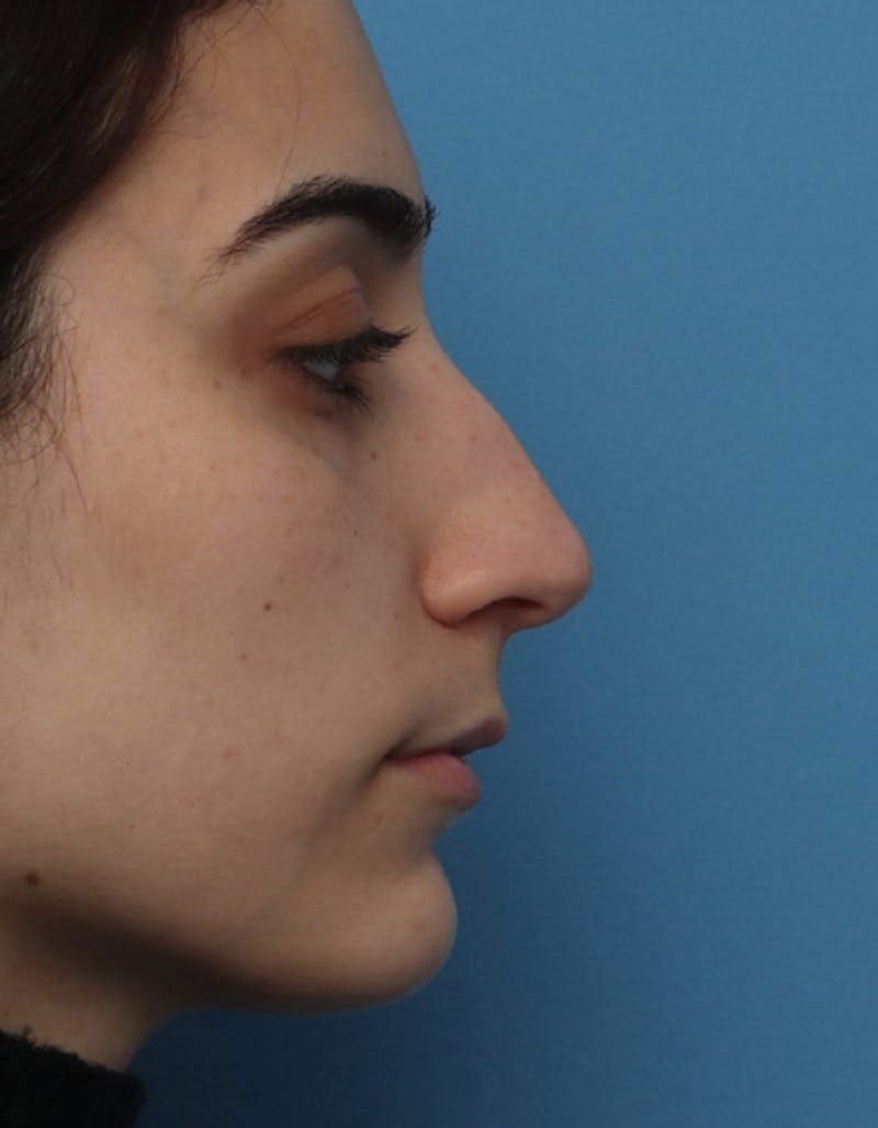 Patient J5XlbW0KQR29Js-2orh4jQ - Rhinoplasty Before & After Photos