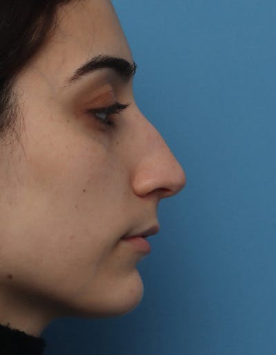 Rhinoplasty Before & After Gallery - Patient 204552 - Image 1