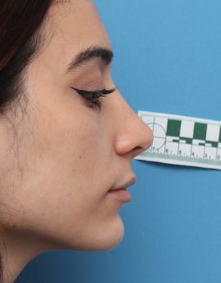 Rhinoplasty Before & After Gallery - Patient 204552 - Image 2