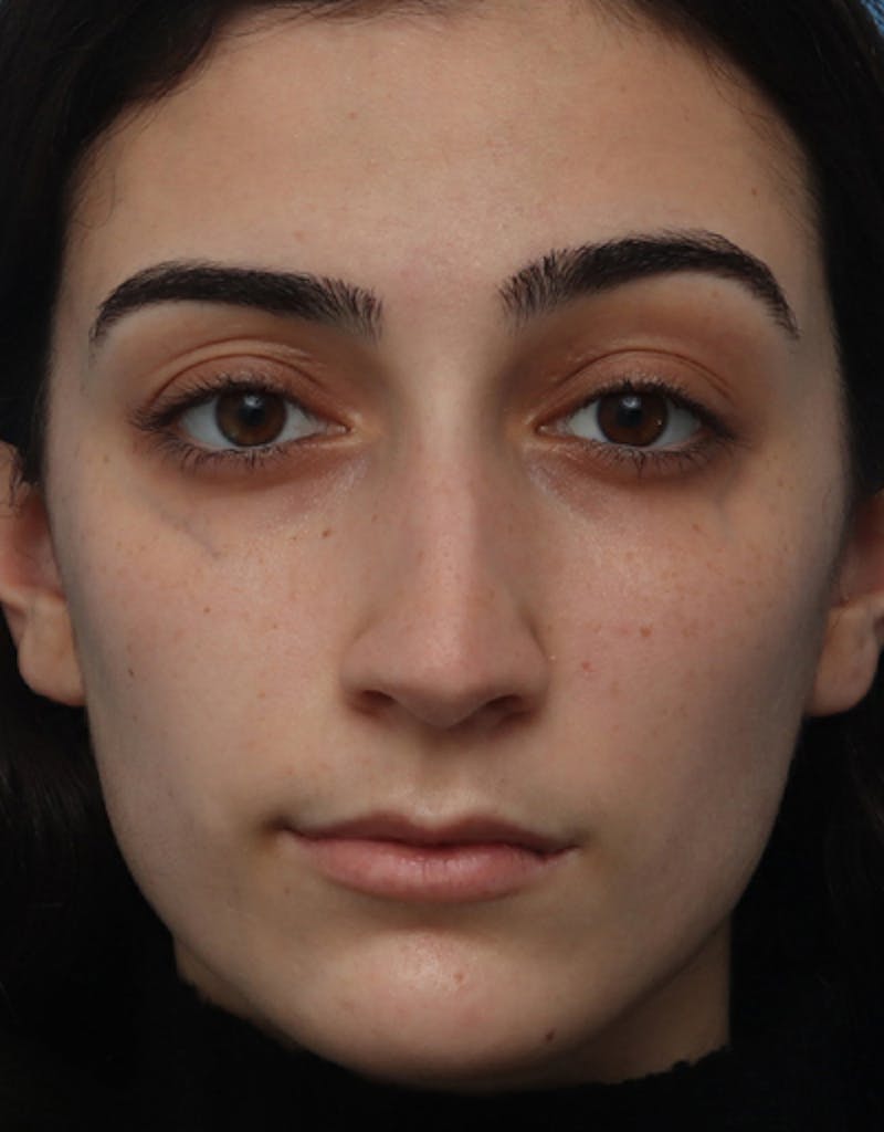 Rhinoplasty Before & After Gallery - Patient 127025 - Image 3