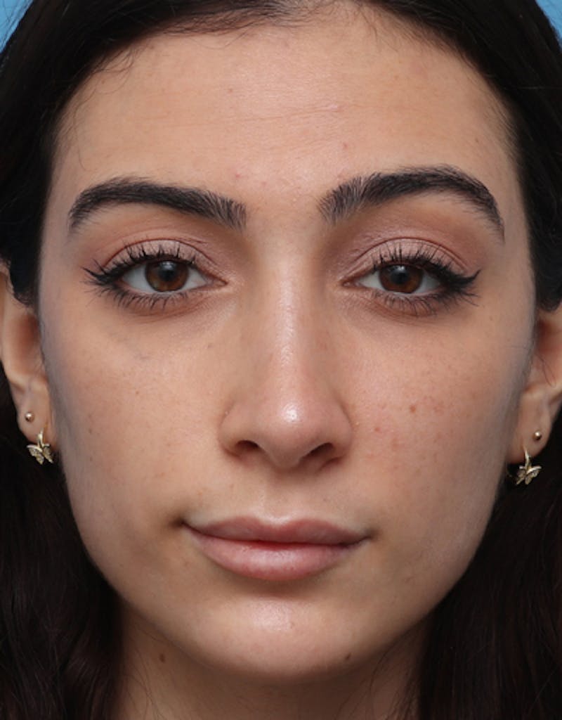 Rhinoplasty  Before & After Gallery - Patient 204552 - Image 4
