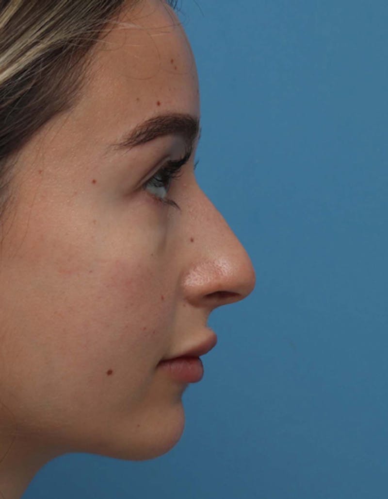 Rhinoplasty Before & After Gallery - Patient 343344 - Image 1