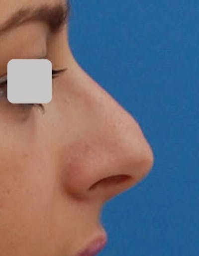 Rhinoplasty Before & After Gallery - Patient 124299 - Image 1