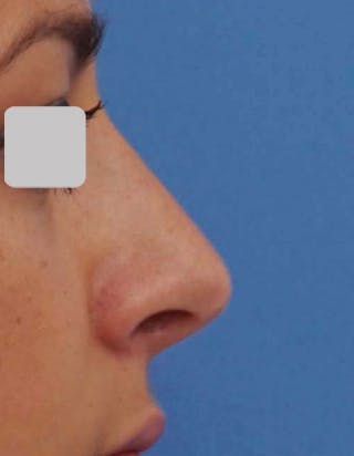 Rhinoplasty Before & After Gallery - Patient 124299 - Image 2