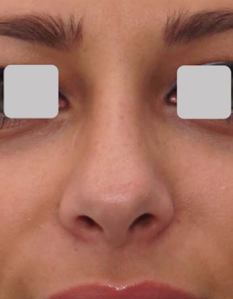 Rhinoplasty  Before & After Gallery - Patient 124299 - Image 4