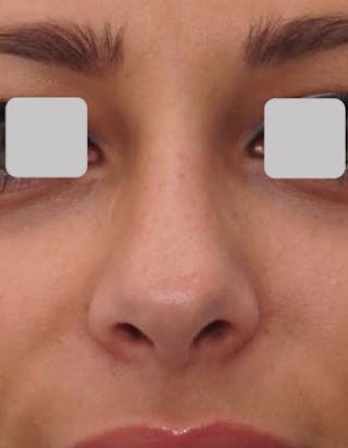 Rhinoplasty Before & After Gallery - Patient 124299 - Image 4