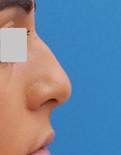 Rhinoplasty Before & After Gallery - Patient 262944 - Image 1