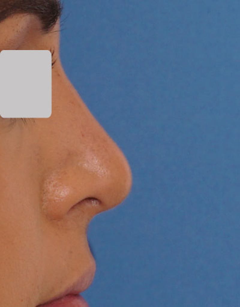 Rhinoplasty Before & After Gallery - Patient 140657 - Image 2