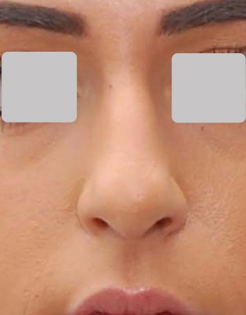 Rhinoplasty Before & After Gallery - Patient 140657 - Image 3