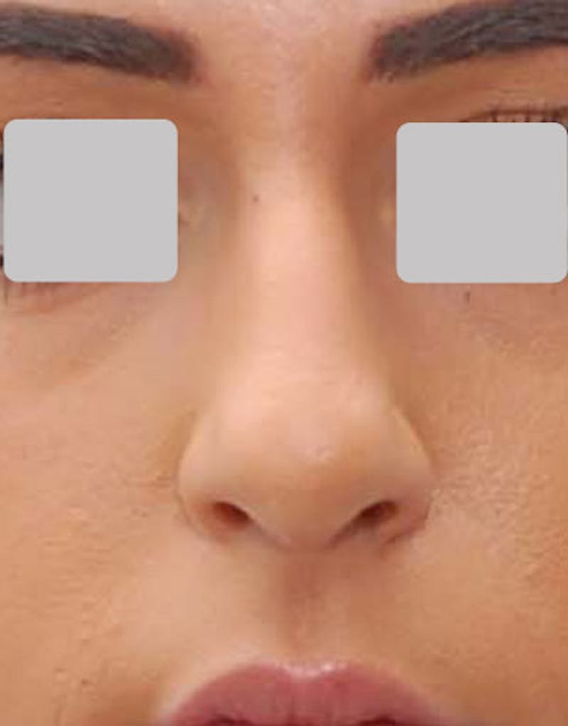 Rhinoplasty  Before & After Gallery - Patient 262944 - Image 3