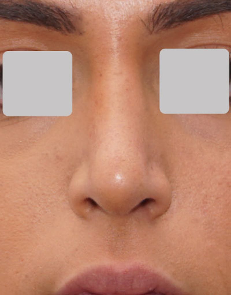 Rhinoplasty Before & After Gallery - Patient 140657 - Image 4